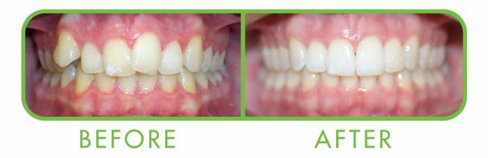 ClearCorrect can produce pleasing results- Before and After photos